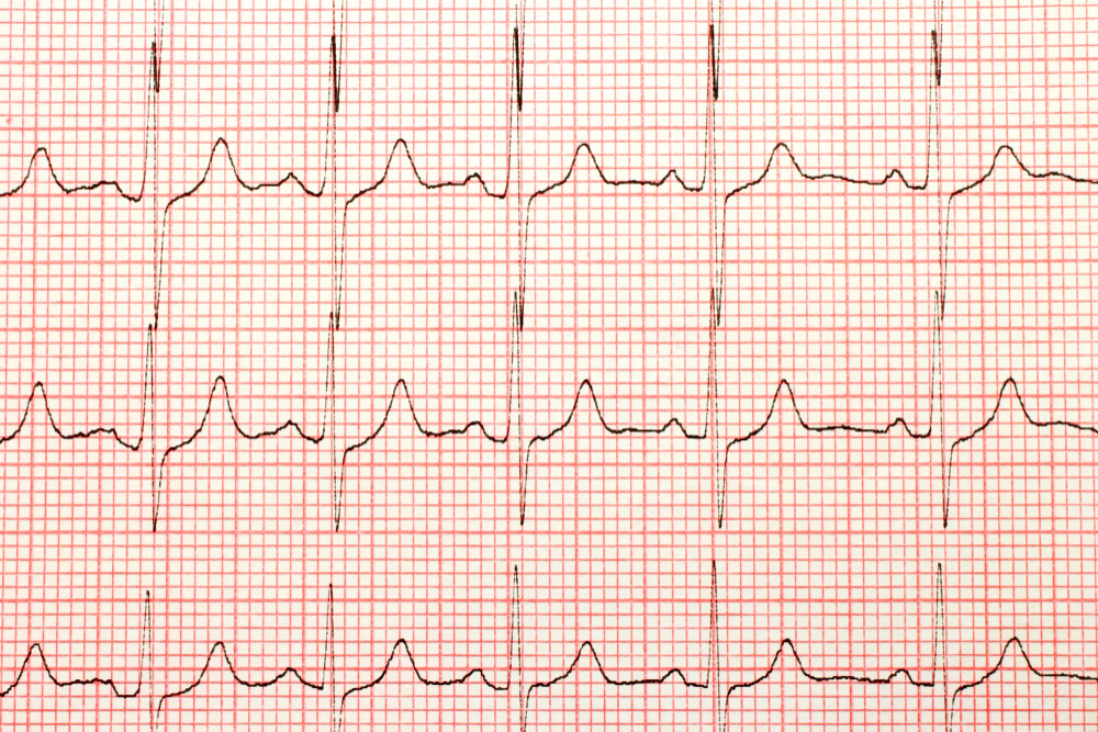 Interpretacja wyników EKG – które parametry powinny zwrócić naszą uwagę?